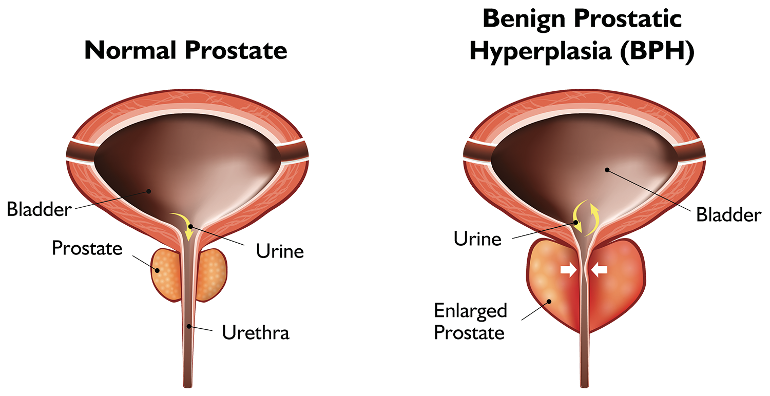 Prostate B&A, BPH